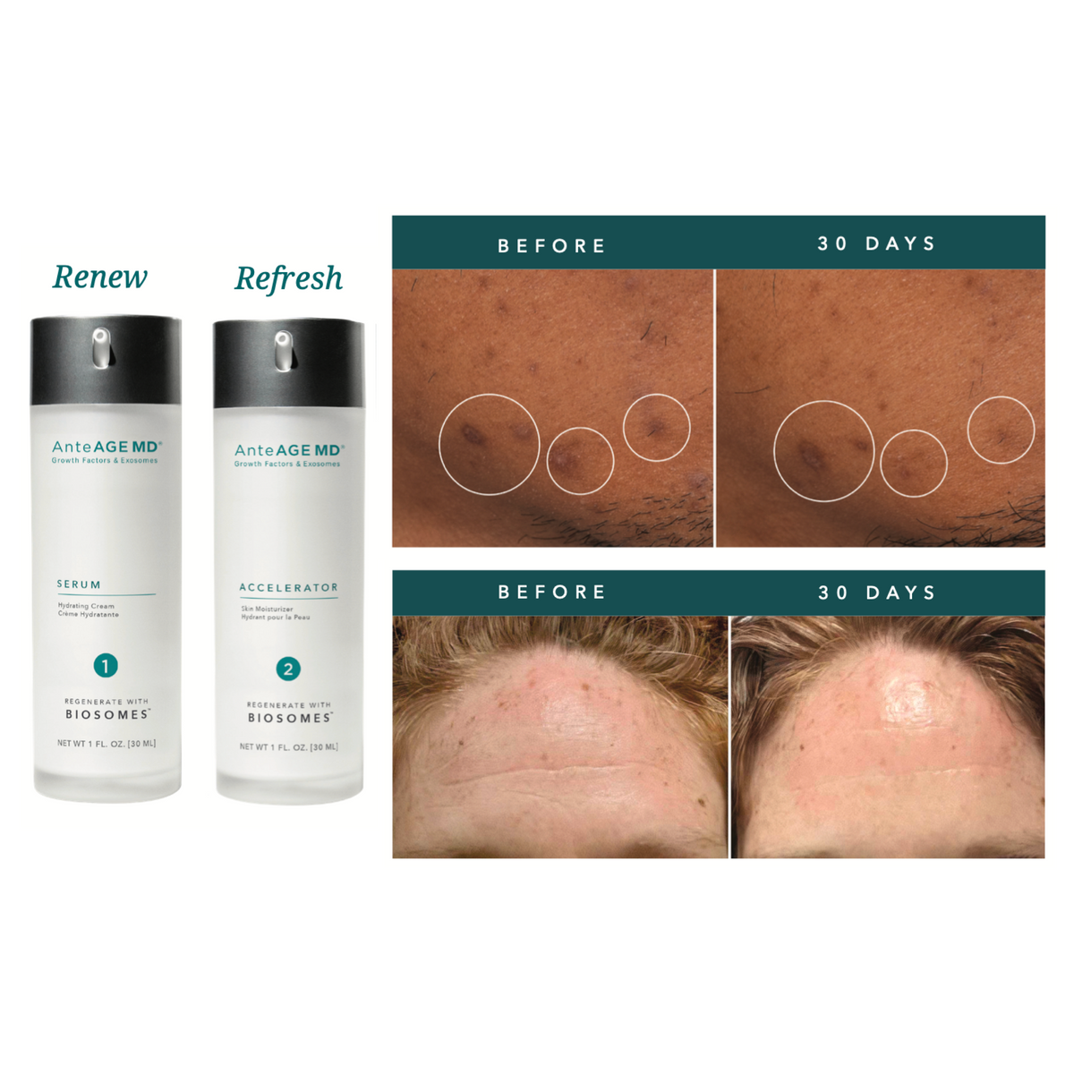 AnteAGE MD Biosome System Serum + Accelerator